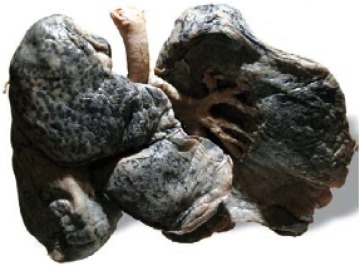 Plastinat einer Raucherlunge Diese Lunge eines Rauchers wurde so präpariert, dass die schwarze Verfärbung durch den Teer deutlich erkennbar ist.